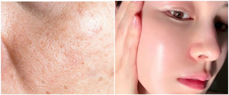 Cara mengecilkan pori-pori ini bikin wajah mulus dan bersih cuma dengan serum dari 1 ampas dapur