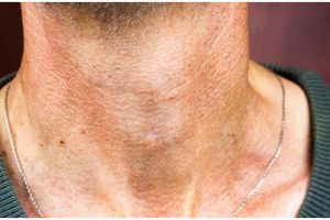 Jadi mulus tanpa lipatan, begini cara mencerahkan leher dekil pakai tambahan 1 bahan minuman