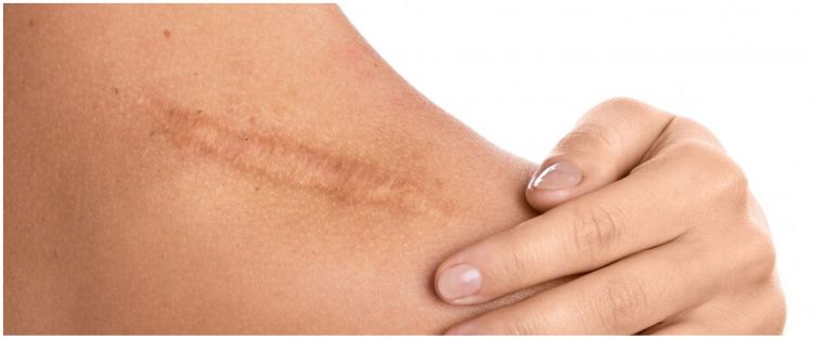 Tanpa diolesi salep, ini cara menghilangkan bekas luka secara alami pakai tambahan 1 bahan dapur