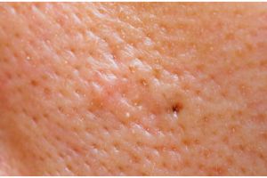 Tak perlu es batu, ini cara mengecilkan pori-pori agar wajah mulus dengan toner dari 2 bahan alami