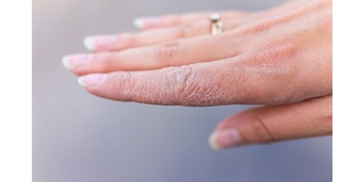 Cara agar tangan kering keriput jadi lembut pakai 1 bahan pemanis, nggak perlu beli hand cream