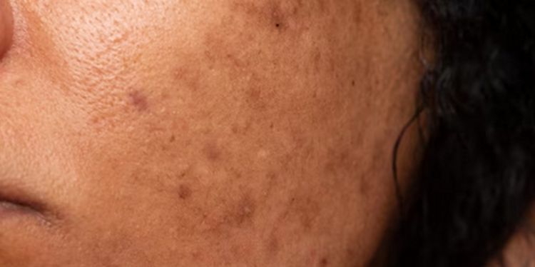  Nggak usah beli serum niacinamide, ini trik hilangkan flek hitam pakai masker dari 2 bahan alami