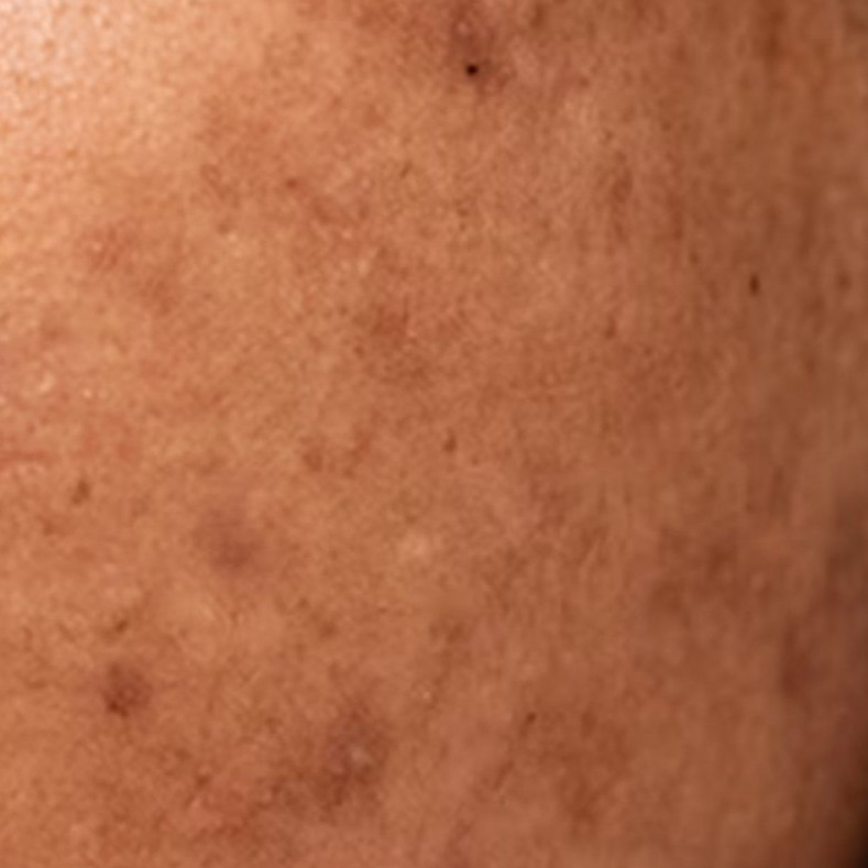  Nggak usah beli serum niacinamide, ini trik hilangkan flek hitam pakai masker dari 2 bahan alami