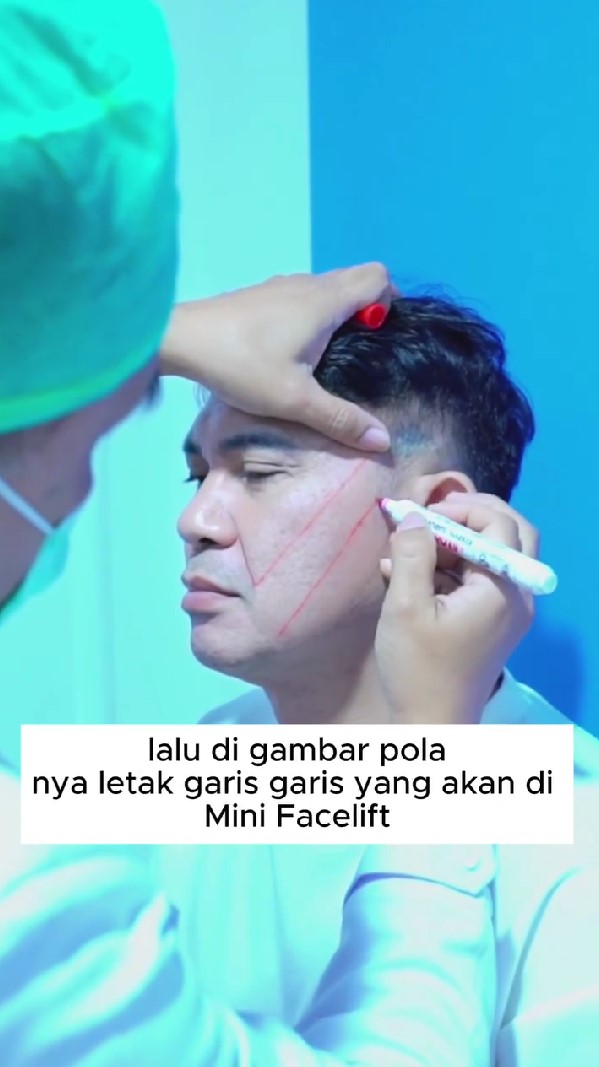 9 Momen Ronny Sianturi jalani oplas agar tampak awet muda, jadi kado diri sendiri di usia 60 tahun
