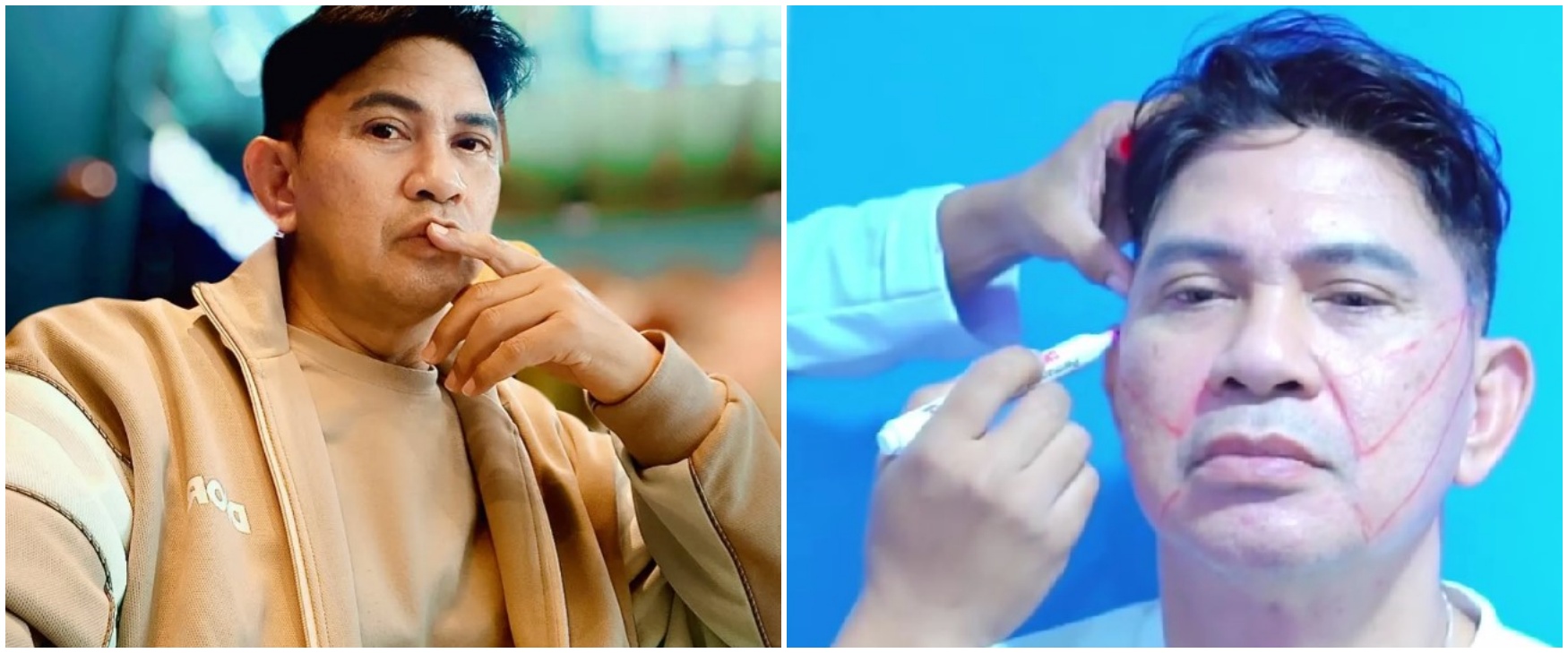 9 Momen Ronny Sianturi jalani oplas agar tampak awet muda, jadi kado diri sendiri di usia 60 tahun