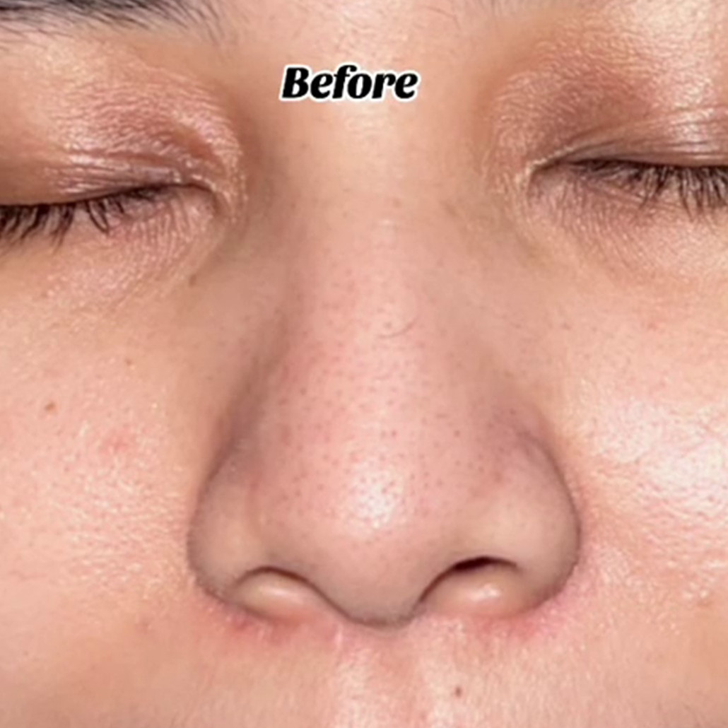 Tak perlu chemical peeling, cara bikin wajah mulus tanpa pori-pori ini ampuh andalkan 1 bahan masakan