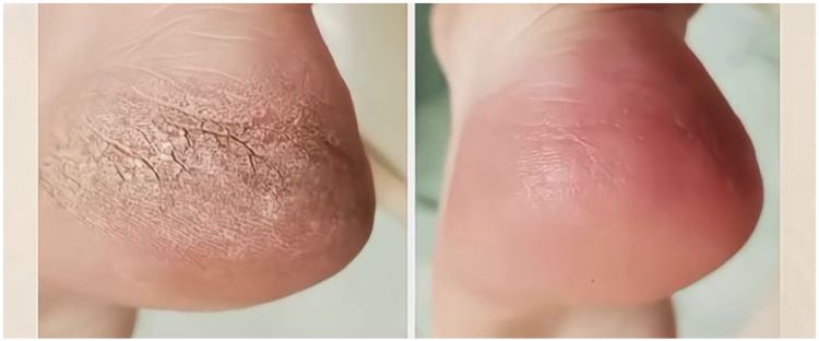 Cara mengatasi kaki kering dan pecah-pecah cuma pakai 1 bahan minuman, nggak perlu lagi pakai lotion