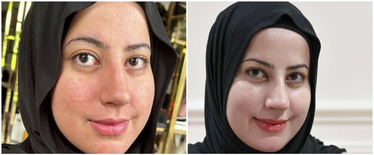 Pernah punya wajah bopeng, ini cara Tasyi Athasyia bikin kulit mulus lagi cuma dalam 1 bulan