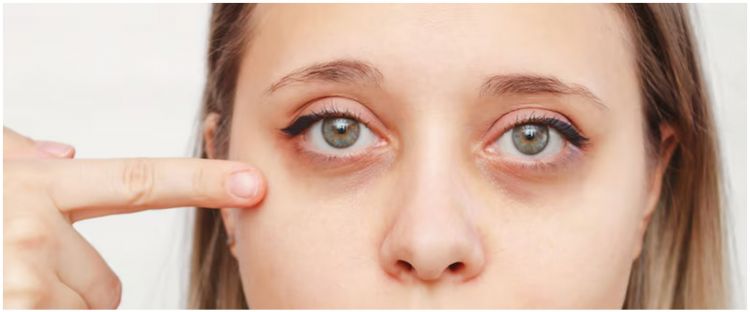 Tak perlu beli produk skincare, cara atasi kantung mata kendur dan hitam cuma dengan 3 bahan dapur