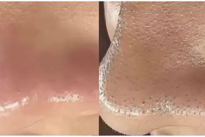 Lebih efektif dari pore pack, ini cara hempaskan komedo dalam 10 menit cuma dengan 1 bahan pemanis
