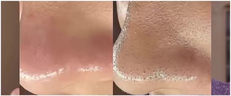 Lebih efektif dari pore pack, ini cara hempaskan komedo dalam 10 menit cuma dengan 1 bahan pemanis