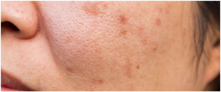 Cara merapatkan pori-pori agar wajah auto mulus pakai 1 bahan dapur, hasilnya auto tampak dalam 7 hari