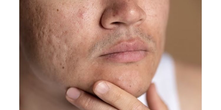 Trik bikin pori-pori mengecil pakai 1 jenis tepung, kulit kasar auto mulus seketika