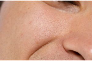 Cara bikin pori-pori rapat dan bersih cuma pakai 2 bahan dapur, bukan pakai lidah buaya