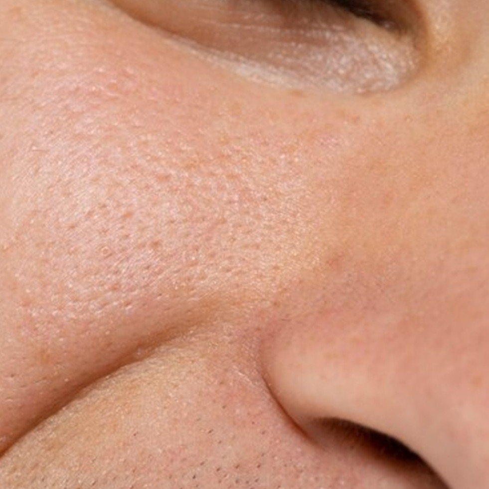 Cara bikin pori-pori rapat dan bersih cuma pakai 2 bahan dapur, bukan pakai lidah buaya