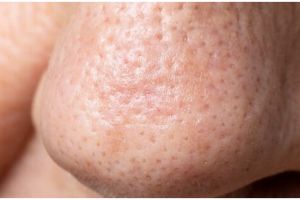 Tanpa air jeruk nipis, ini cara alami mengecilkan pori-pori lebar tanpa bikin wajah perih