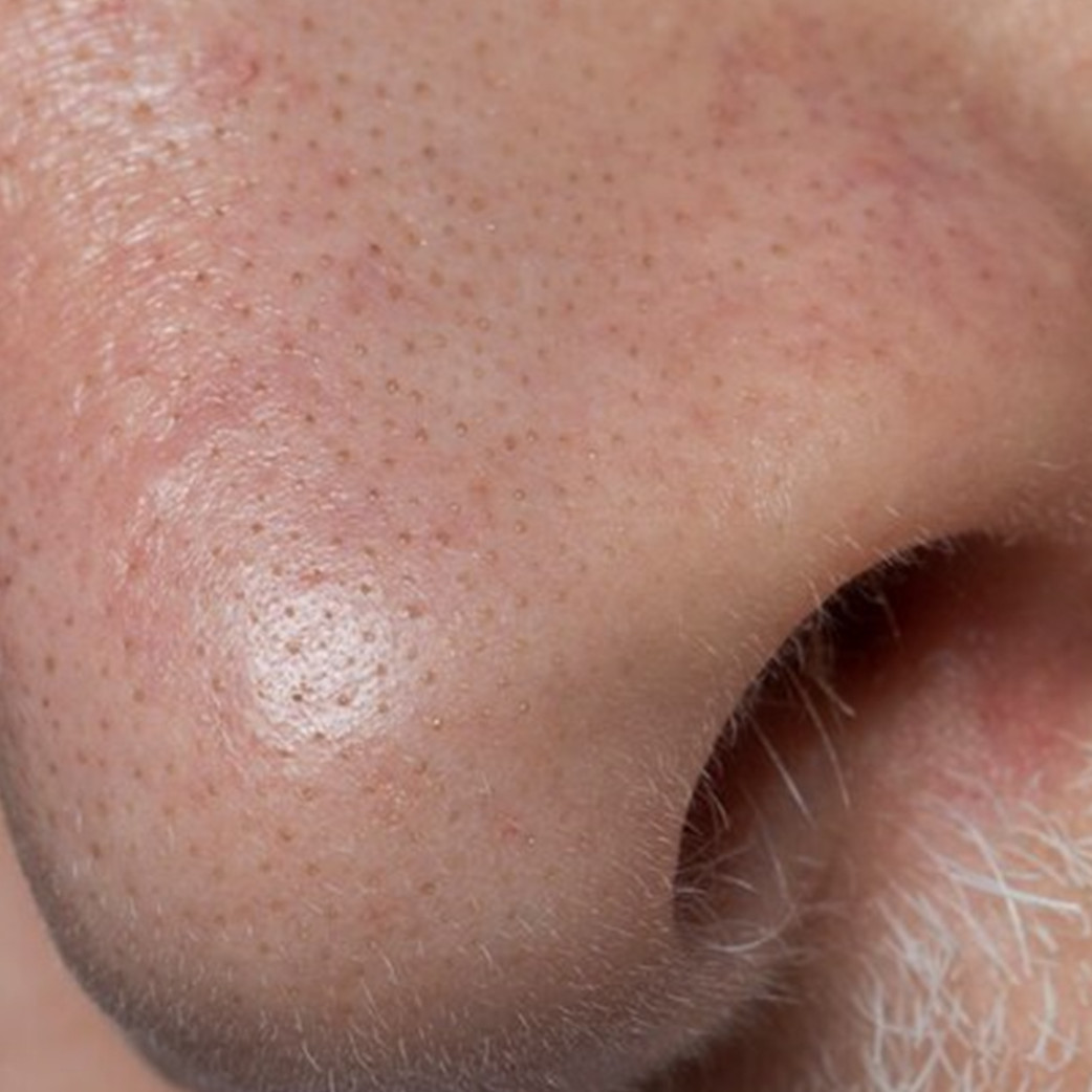 Tanpa air beras, begini cara alami samarkan pori-pori besar pakai masker dari 1 jenis protein