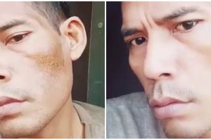 Hasil langsung terlihat, begini cara alami menghilangkan flek hitam cuma dengan 1 ampas dapur