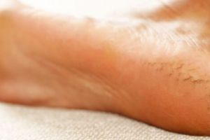 Cara menghaluskan tumit pecah-pecah pakai 1 jenis buah-buahan, bukan dengan madu maupun cuka apel