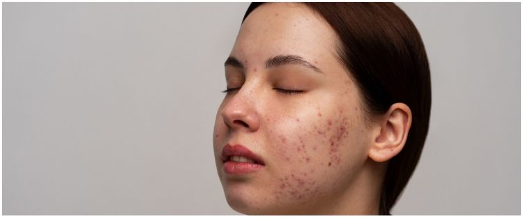 Tak butuh acne gel, ini cara menghilangkan bekas jerawat membandel cuma dengan 1 jenis umbi-umbian