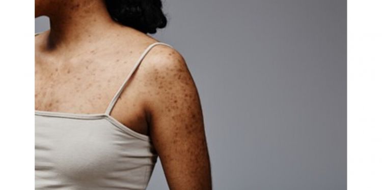 Cara rontokkan daki badan tanpa sisa pakai 1 jenis ampas minuman, bisa sekalian jaga lingkungan