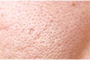 Wajah mulus dan bening tanpa skincare, ini cara alami mengecilkan pori-pori pakai 1 bahan pemanis