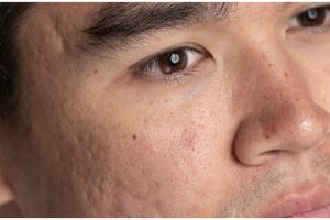 Cara mengecilkan pori-pori wajah secara alami ini bantu basmi komedo meski tanpa scrub