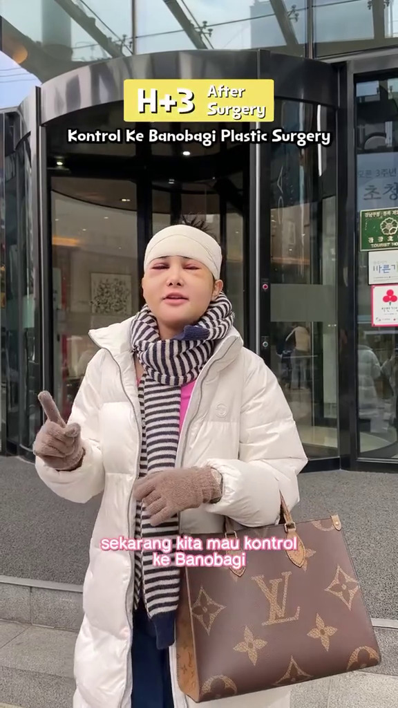 9 Potret Dilan jalani operasi plastik usai diselingkuhi suami, warganet ungkap kekecewaan