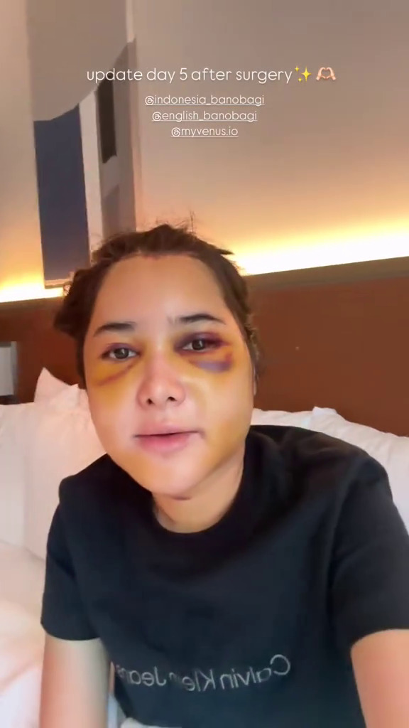 9 Potret Dilan jalani operasi plastik usai diselingkuhi suami, warganet ungkap kekecewaan