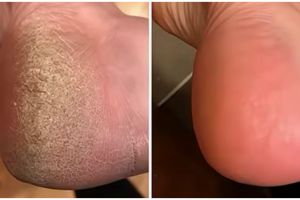 Cara mudah mengatasi kaki kering dan pecah-pecah ini ampuh bikin mulus tanpa salep atau obat-obatan