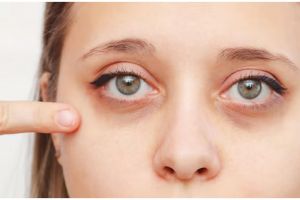 Trik samarkan kantung mata menghitam pakai 1 jenis buah-buahan, nggak perlu lagi beli eyecream