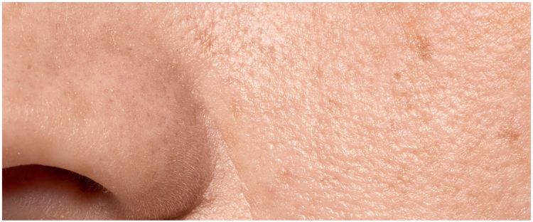 Tanpa putih telur, ini cara mengecilkan pori-pori besar agar wajah mulus tak bertekstur