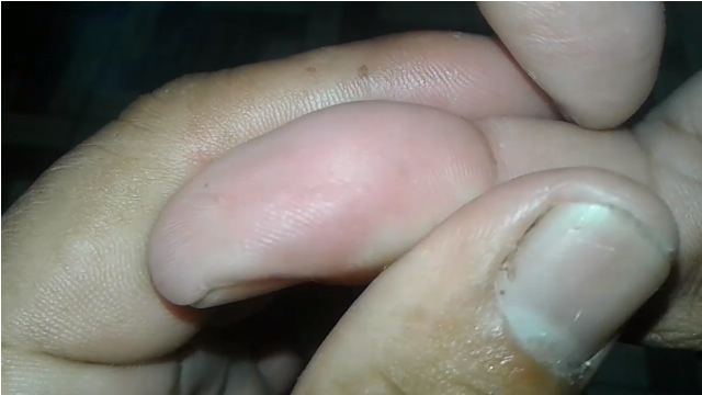 Trik mudah mengeluarkan duri ikan di tangan tanpa rasa sakit ditusuk jarum, aman pakai 1 bahan dapur