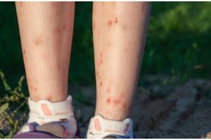 Noda hitam di kaki auto pudar, begini trik hilangkan bekas gigitan nyamuk pakai 1 bahan lalapan