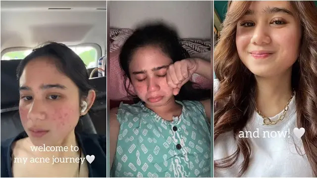 6 Potret Tissa Biani 4 tahun jadi pejuang jerawat, kerap nangis saat bercermin, ajarkan kesabaran
