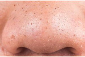 Cara bikin toner untuk kecilkan pori-pori dan kencangkan kulit wajah, praktis pakai 1 ampas dapur