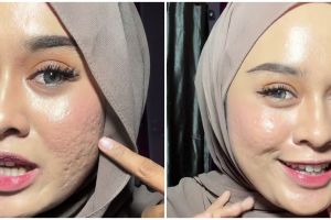 Bukan diset bedak padat, ini trik mengatasi makeup bertekstur agar lebih blurring pada wajah bopeng