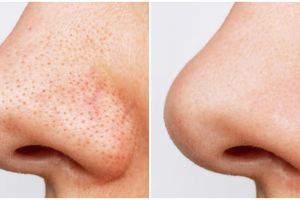 Kulit jadi makin halus, ini cara aman kecilkan pori-pori besar tanpa bikin iritasi pakai 3 bahan dapur