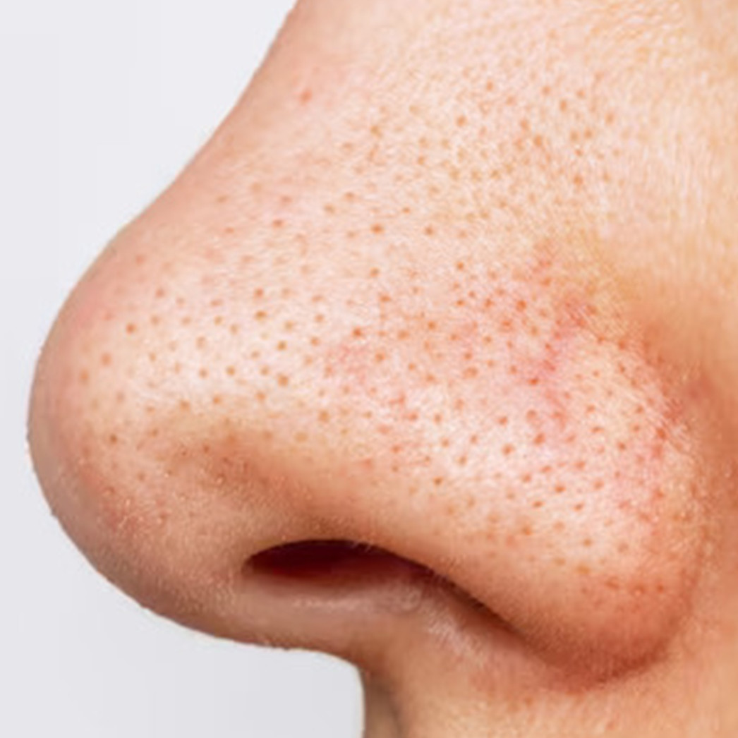 Kulit jadi makin halus, ini cara aman kecilkan pori-pori besar tanpa bikin iritasi pakai 3 bahan dapur