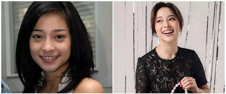 Rela habiskan uang puluhan juta rupiah, ini 10 potret penyanyi sebelum dan sesudah veneer gigi