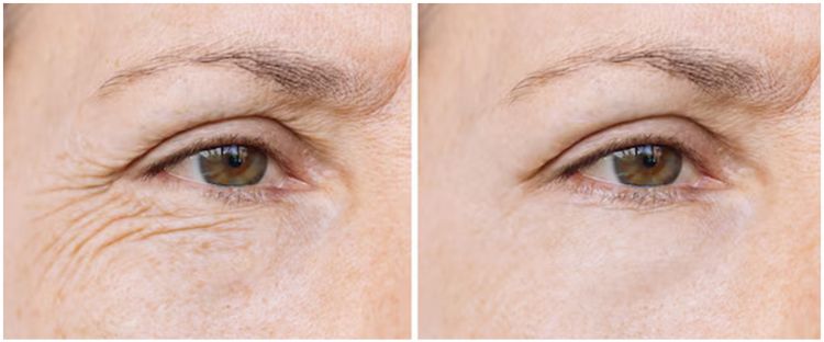 Kerap jadi tanda penuaan, ini cara menghilangkan kerutan halus di bawah mata cuma pakai 1 jenis rempah