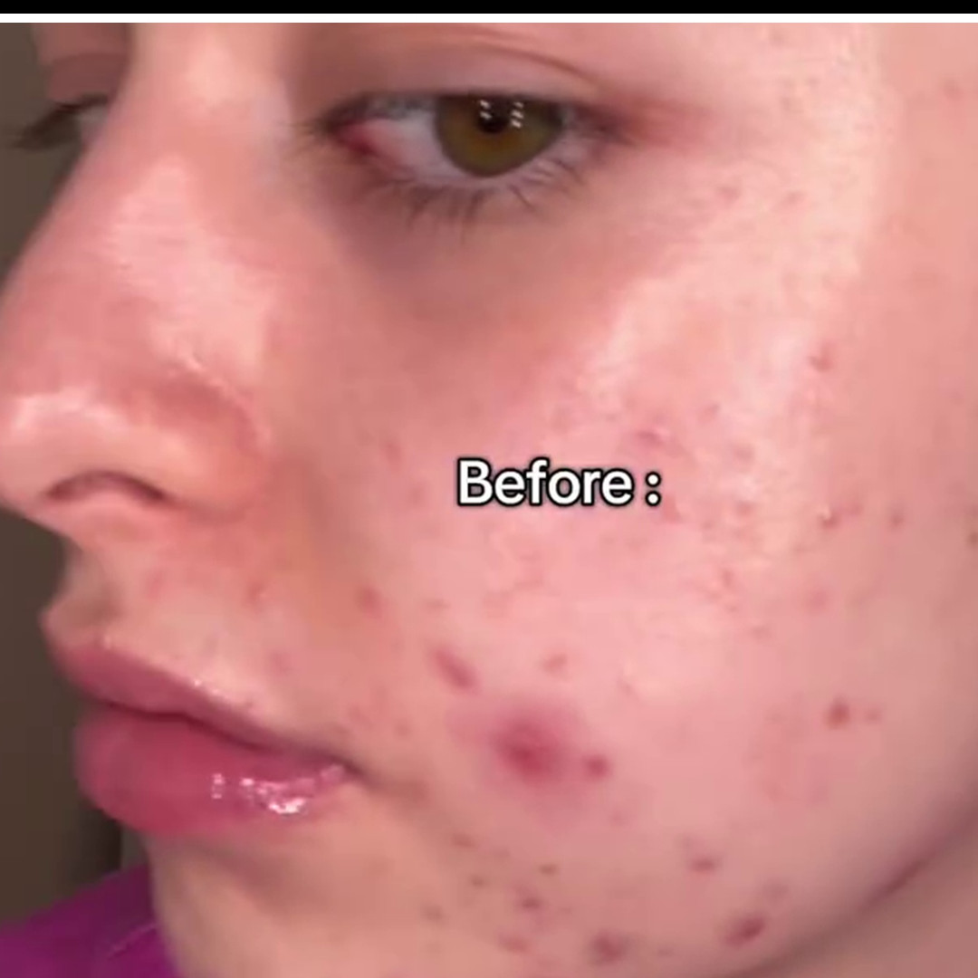 Bekas jerawat meradang? Begini cara menghilangkannya cuma dengan masker dari 3 bahan dapur