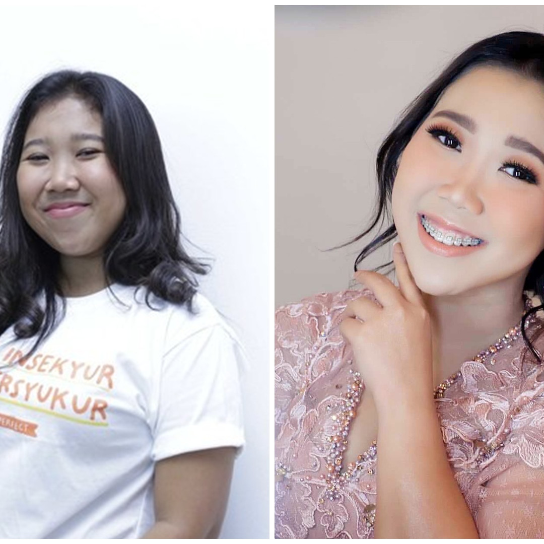 Potret wajah 15 seleb sebelum dan sesudah permak dagu, perubahannya drastis jadi tampak tirus