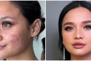 Bukan langsung diset foundation, ini trik menutup bekas jerawat dan bopeng agar makeup lebih smooth