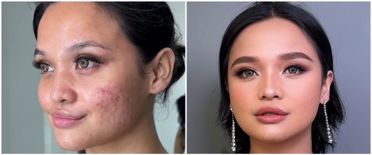 Bukan langsung diset foundation, ini trik menutup bekas jerawat dan bopeng agar makeup lebih smooth