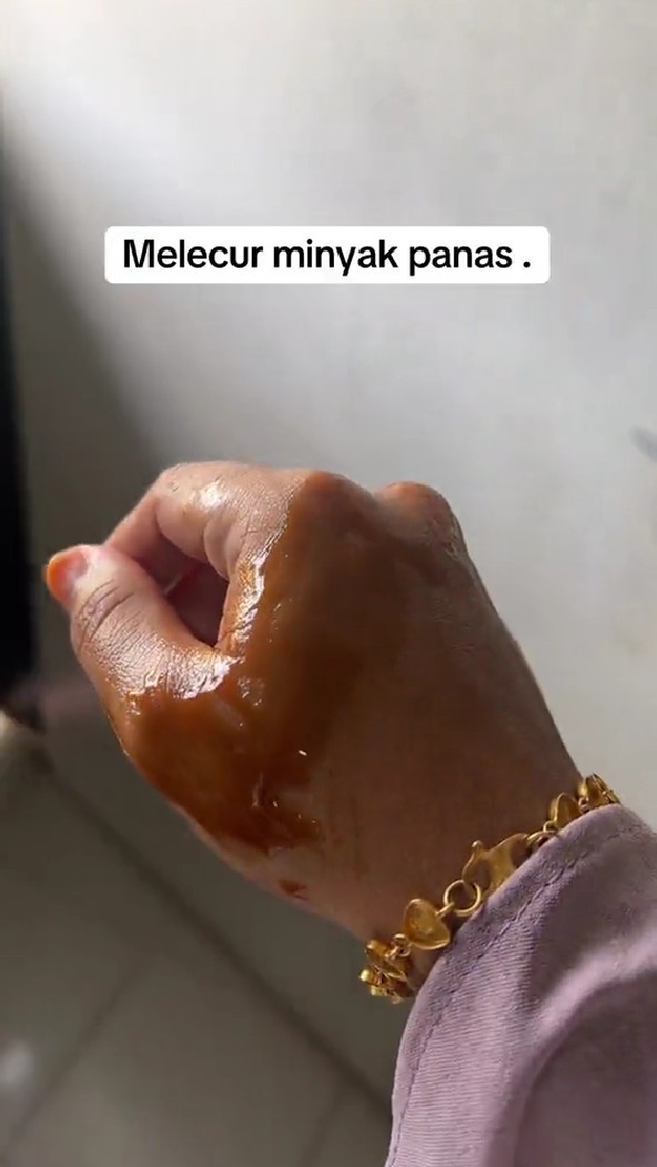 Trik agar tangan terkena minyak panas tak melepuh tanpa dioles pasta gigi, cuma pakai 1 bahan masakan