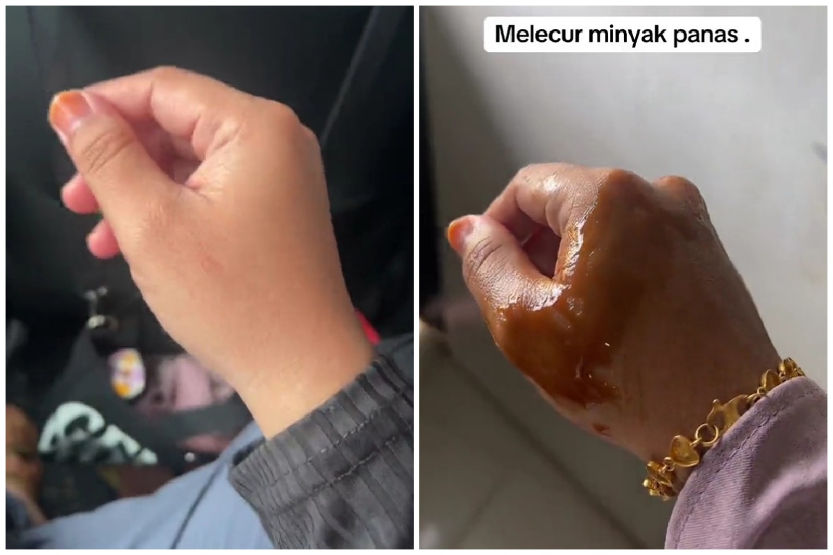 Trik agar tangan terkena minyak panas tak melepuh tanpa dioles pasta gigi, cuma pakai 1 bahan masakan