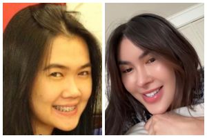 Ternyata pernah pasang kawat gigi, ini 7 transformasi Michelle Halim sebelum dan sesudah pakai behel