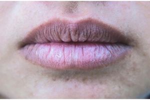 Cara mengatasi kulit sekitar bibir yang menghitam agar tak belang lagi dan lebih cerah
