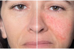 Bukan dikompres es batu, ini cara aman mengurangi kemerahan di wajah tanpa bikin iritasi